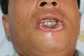 Cắn đứt môi vì thách đố nhau khi uống rượu Cắn đứt môi vì thách đố nhau khi uống rượu