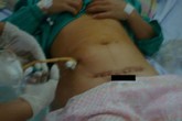 Những sản phụ có nguy cơ vỡ tử cung Những sản phụ có nguy cơ vỡ tử cung
