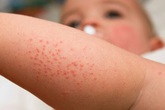 Trẻ em hay dị ứng với thực phẩm nào? Trẻ em hay dị ứng với thực phẩm nào?