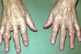 Bệnh gout và nỗi sợ hãi kinh hoàng Bệnh gout và nỗi sợ hãi kinh hoàng