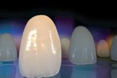 Nhổ răng bao lâu có thể trồng răng sứ? Nhổ răng bao lâu có thể trồng răng sứ?