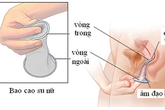 Bao cao su cho phái nữ, bảo bối giúp tránh thai và ngừa bệnh tình dục Bao cao su cho phái nữ, bảo bối giúp tránh thai và ngừa bệnh tình dục