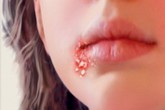 Cách điều trị bệnh zona ở mặt Cách điều trị bệnh zona ở mặt