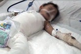 Mẹ đi vệ sinh, bé gái 2 tuổi bị cả nồi canh đang sôi đổ lên người Mẹ đi vệ sinh, bé gái 2 tuổi bị cả nồi canh đang sôi đổ lên người