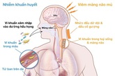 Dấu hiệu cảnh báo bệnh viêm não mô cầu Dấu hiệu cảnh báo bệnh viêm não mô cầu