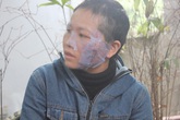 Chồng dí bát sắt nung đỏ vào mặt vợ vì "tội" tham gia đa cấp Chồng dí bát sắt nung đỏ vào mặt vợ vì "tội" tham gia đa cấp