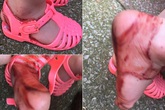 Chỉ vì đôi sandal này bé gái 2 tuổi đã phải chịu đau đớn khủng khiếp Chỉ vì đôi sandal này bé gái 2 tuổi đã phải chịu đau đớn khủng khiếp