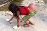 Bé gái Mông có khối u dị thường, đủ chân tay vẫn phải đi bằng 4 chi Bé gái Mông có khối u dị thường, đủ chân tay vẫn phải đi bằng 4 chi