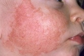 Bị chàm sữa ( lác sữa) chữa thuốc gì ? Bị chàm sữa ( lác sữa) chữa thuốc gì ?