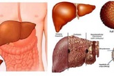 Cách phát hiện mắc bệnh gan nhanh chóng chỉ sau 10 phút Cách phát hiện mắc bệnh gan nhanh chóng chỉ sau 10 phút