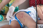 Cẩn trọng bệnh tay chân miệng “vào mùa”: Kiêng kỵ vô lối, bệnh càng nặng hơn Cẩn trọng bệnh tay chân miệng “vào mùa”: Kiêng kỵ vô lối, bệnh càng nặng hơn
