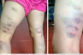 Cô giáo đánh học sinh bầm tím 2 chân chỉ bị kiểm điểm vì... là họ hàng Cô giáo đánh học sinh bầm tím 2 chân chỉ bị kiểm điểm vì... là họ hàng