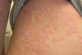 Báo cáo toàn cầu của WHO về bệnh vẩy nến Báo cáo toàn cầu của WHO về bệnh vẩy nến