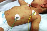 TPHCM: Bé 5 tháng tuổi tử vong do viêm não mô cầu TPHCM: Bé 5 tháng tuổi tử vong do viêm não mô cầu