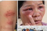 Hà Nội: Kiến ba khoang lộng hành, nhiều người bị đốt thê thảm Hà Nội: Kiến ba khoang lộng hành, nhiều người bị đốt thê thảm