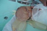 Mẹ bất cẩn để con ngã ngồi vào nồi canh nóng 25 lít Mẹ bất cẩn để con ngã ngồi vào nồi canh nóng 25 lít