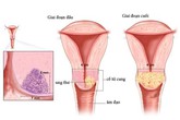 4 bước phát hiện sớm ung thư cổ tử cung 4 bước phát hiện sớm ung thư cổ tử cung