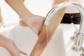 Những việc nên và không nên làm khi trẻ bị bỏng nước sôi Những việc nên và không nên làm khi trẻ bị bỏng nước sôi