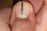 Móng tay có sọc đen, đau đớn dấu hiệu u ác tính Móng tay có sọc đen, đau đớn dấu hiệu u ác tính