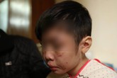 Khởi tố bố đẻ và mẹ kế bạo hành bé trai 10 tuổi ở Hà Nội Khởi tố bố đẻ và mẹ kế bạo hành bé trai 10 tuổi ở Hà Nội