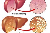 7 dấu hiệu không ngờ tới cảnh báo gan của bạn đang xấu đi 7 dấu hiệu không ngờ tới cảnh báo gan của bạn đang xấu đi