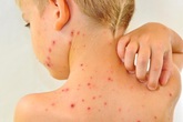 Bố mẹ nhầm thủy đậu với bệnh sởi, nhiều trẻ nguy kịch Bố mẹ nhầm thủy đậu với bệnh sởi, nhiều trẻ nguy kịch
