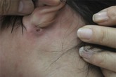 Sốt cao, bác sĩ truy tìm nốt mẩn ở “vùng hiểm” để chẩn bệnh Sốt cao, bác sĩ truy tìm nốt mẩn ở “vùng hiểm” để chẩn bệnh