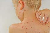 Cẩn trọng với các loại dị ứng trẻ dễ gặp mùa hè Cẩn trọng với các loại dị ứng trẻ dễ gặp mùa hè