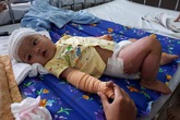 Bé gái bị ngã vào bếp lửa phải lấy da của bố để cấy ghép Bé gái bị ngã vào bếp lửa phải lấy da của bố để cấy ghép