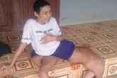 Xót xa chàng thanh niên suốt 7 năm mang chân “voi” Xót xa chàng thanh niên suốt 7 năm mang chân “voi”