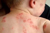 Khi côn trùng đốt, chớ lạm dụng mẹo dân gian Khi côn trùng đốt, chớ lạm dụng mẹo dân gian