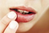 Những cách đối phó với nhiệt miệng Những cách đối phó với nhiệt miệng