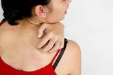 Dị ứng hải sản - Xử trí thế nào? Dị ứng hải sản - Xử trí thế nào?