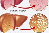 Những dấu hiệu cảnh báo bạn có dấu hiệu bị gan nhiễm mỡ Những dấu hiệu cảnh báo bạn có dấu hiệu bị gan nhiễm mỡ