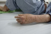 Cô gái 29 năm chiến đấu với căn bệnh lột da như rắn Cô gái 29 năm chiến đấu với căn bệnh lột da như rắn