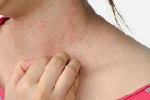 Những bệnh “tác oai, tác quái” vào ngày nắng nóng (1): Mẩn ngứa, mụn nhọt do gan suy giảm chức năng Những bệnh “tác oai, tác quái” vào ngày nắng nóng (1): Mẩn ngứa, mụn nhọt do gan suy giảm chức năng