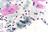 Nấm Candida sinh dục - 'cứng đầu' nhưng không bất trị Nấm Candida sinh dục - 'cứng đầu' nhưng không bất trị