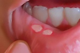 Mẹo chữa nhiệt miệng nhanh lành tại nhà cực đơn giản Mẹo chữa nhiệt miệng nhanh lành tại nhà cực đơn giản
