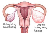 10 dấu hiệu ung thư buồng trứng cực kì nguy hiểm 10 dấu hiệu ung thư buồng trứng cực kì nguy hiểm