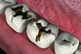 Chỉ vì một cái răng sâu mà tử vong, đừng chủ quan trong điều trị Chỉ vì một cái răng sâu mà tử vong, đừng chủ quan trong điều trị