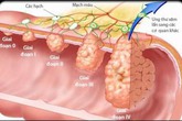 3 cách phát hiện sớm, loại bỏ ung thư đại trực tràng từ "trứng nước" 3 cách phát hiện sớm, loại bỏ ung thư đại trực tràng từ "trứng nước"