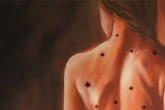Nốt ruồi – dấu hiệu báo ung thư bạn cần biết Nốt ruồi – dấu hiệu báo ung thư bạn cần biết