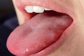 Giám đốc BV Ung bướu cảnh báo 3 dấu hiệu vùng đầu cổ phải nghĩ ngay đến ung thư lưỡi Giám đốc BV Ung bướu cảnh báo 3 dấu hiệu vùng đầu cổ phải nghĩ ngay đến ung thư lưỡi