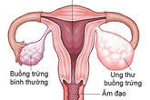 6 dấu hiệu cảnh báo bệnh ung thư buồng trứng, chị em cần lưu ý 6 dấu hiệu cảnh báo bệnh ung thư buồng trứng, chị em cần lưu ý