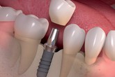 Tiết kiệm thời gian trồng răng Implant với ETK Active Tiết kiệm thời gian trồng răng Implant với ETK Active