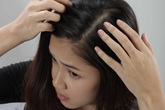 Giải pháp đặc trị cho tóc gàu Giải pháp đặc trị cho tóc gàu