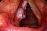 GĐ BV Tai Mũi Họng: Bất kỳ ai có dấu hiệu này 5 - 7 ngày không đỡ phải đi khám ung thư ngay GĐ BV Tai Mũi Họng: Bất kỳ ai có dấu hiệu này 5 - 7 ngày không đỡ phải đi khám ung thư ngay