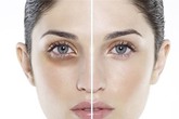 Bạn bối rối vì quầng thâm mắt, vậy hãy xem chúng xuất hiện như thế nào? Bạn bối rối vì quầng thâm mắt, vậy hãy xem chúng xuất hiện như thế nào?