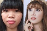 Bỏ 200 triệu để thẩm mỹ mặt, "Thị Nở tái sinh" đổi đời ra sao? Bỏ 200 triệu để thẩm mỹ mặt, "Thị Nở tái sinh" đổi đời ra sao?