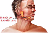 Nhiều người nhầm quai bị với bệnh nguy hiểm Nhiều người nhầm quai bị với bệnh nguy hiểm